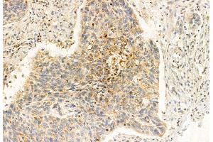 ABIN6261583 and ABIN6272916 at 1/100 staining Human lung cancer by IHC-P.