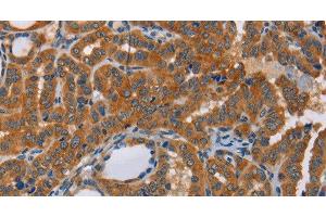 Immunohistochemistry of paraffin-embedded Human thyroid cancer tissue using CK-13 Polyclonal Antibody at dilution 1:50