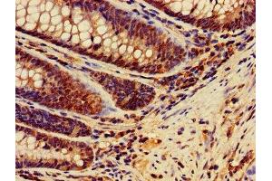 IHC image of ABIN7150205 diluted at 1:400 and staining in paraffin-embedded human colon cancer performed on a Leica BondTM system.