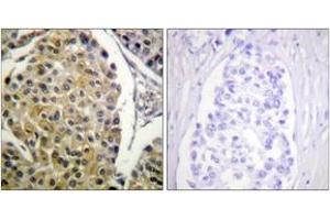 Immunohistochemistry analysis of paraffin-embedded human breast carcinoma, using PKC delta (Phospho-Tyr313) Antibody. (PKC delta anticorps  (pTyr313))