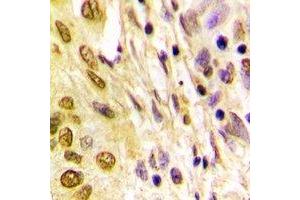 Immunohistochemical analysis of Histone H4 (AcK5) staining in human lung cancer formalin fixed paraffin embedded tissue section.