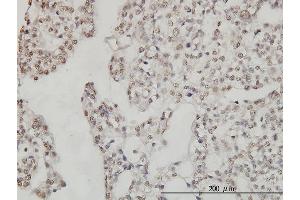 Immunoperoxidase of monoclonal antibody to DDX54 on formalin-fixed paraffin-embedded human ovary, clear cell carcinoma.