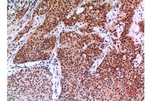 Immunohistochemistry (IHC) analysis of paraffin-embedded Human Mammary Cancer, antibody was diluted at 1:100.
