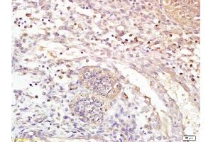 Formalin-fixed and paraffin embedded human endometrial carcinoma tissue labeled with Anti LTB4-R1 Polyclonal Antibody,Unconjugated  at 1:100 followed by conjugation to the secondary antibody and DAB staining.