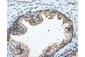 Immunohistochemical staining of paraffin-embedded Adenocarcinoma of colon tissue using anti-ARHGDIA mouse monoclonal antibody. (ARHGDIA anticorps)