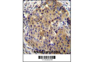 ST14 Antibody immunohistochemistry analysis in formalin fixed and paraffin embedded human breast carcinoma followed by peroxidase conjugation of the secondary antibody and DAB staining. (ST14 anticorps  (C-Term))