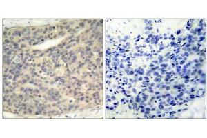 Immunohistochemical analysis of paraffin- embedded human breast carcinoma tissue, using LIMK1 (phospho- Thr508) antibody (E011126). (LIM Domain Kinase 1 anticorps  (pThr508))