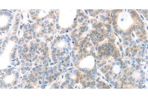 Immunohistochemistry of paraffin-embedded Human thyroid cancer using MAGED1 Polyclonal Antibody at dilution of 1:30 (MAGED1 anticorps)
