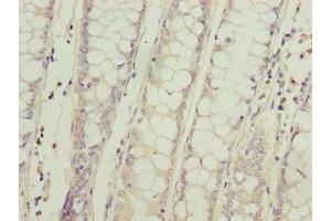Immunohistochemistry of paraffin-embedded human colon cancer using ABIN7169615 at dilution of 1:100