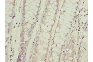 Immunohistochemistry of paraffin-embedded human colon cancer using ABIN7169615 at dilution of 1:100 (SPCS2 anticorps  (AA 7-86))