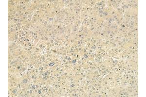 ABIN6261001 and ABIN6279253 at 1/100 staining human hepatocellular carcinoma by IHC-P. (CPD anticorps  (N-Term))