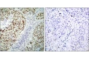 Immunohistochemistry analysis of paraffin-embedded human breast carcinoma tissue, using p53 (Ab-6) Antibody. (p53 anticorps  (AA 1-50))