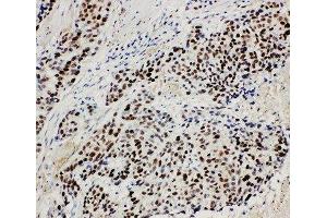 Anti-MCM3 antibody, IHC(P) IHC(P): Human Lung Cancer Tissue