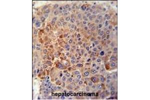 GPLD1 Antibody (C-term) (ABIN389063 and ABIN2839268) immunohistochemistry analysis in formalin fixed and paraffin embedded human hepatocarcinoma tissue followed by peroxidase conjugation of the secondary antibody and DAB staining. (GPLD1 anticorps  (C-Term))