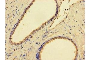 Immunohistochemistry of paraffin-embedded human prostate cancer using ABIN7158978 at dilution of 1:100