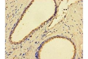 Immunohistochemistry of paraffin-embedded human prostate cancer using ABIN7158978 at dilution of 1:100 (GMPPB anticorps  (AA 61-360))