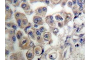 Immunohistochemistry analyzes of PLC β3 antibody in paraffin-embedded human breast carcinoma tissue. (PLCB3 anticorps)