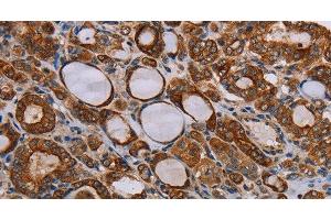 Immunohistochemistry of paraffin-embedded Human thyroid cancer tissue using FABP3 Polyclonal Antibody at dilution 1:40