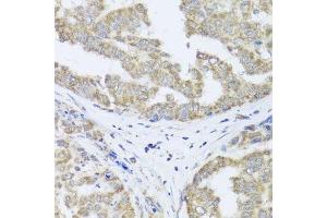 Immunohistochemistry of paraffin-embedded human liver cancer using TIMM10B antibody. (TIMM10B anticorps  (AA 1-103))