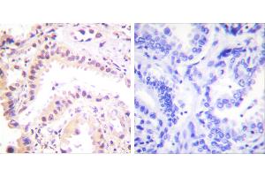 Peptide - +Immunohistochemical analysis of paraffin-embedded human lung carcinoma tissue using Cullin 2 antibody (#C0163). (Cullin 2 anticorps)