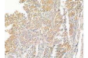 ABIN6263107 and ABIN6267016 at 1/100 staining human lung squamous cell carcinoma by IHC-P. (MAP3K4 anticorps  (N-Term))