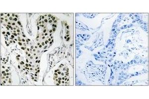 Immunohistochemistry analysis of paraffin-embedded human breast carcinoma tissue, using ZC3H4 Antibody.