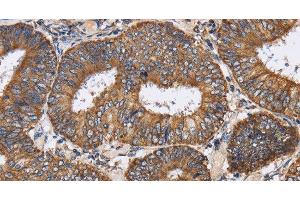 Immunohistochemistry of paraffin-embedded Human colon cancer tissue using PDGFC Polyclonal Antibody at dilution 1:40 (PDGFC anticorps)