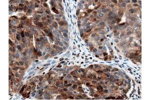 Immunohistochemical staining of paraffin-embedded Adenocarcinoma of Human colon tissue using anti-NT5DC1 mouse monoclonal antibody. (NT5DC1 anticorps)