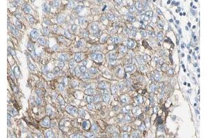 ABIN6268724 at 1/100 staining human lung carcinoma sections by IHC-P. (PAI1 anticorps  (Internal Region))
