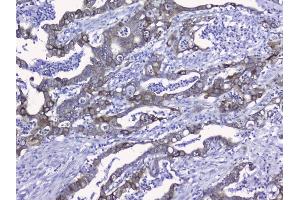 IHC analysis of Cytokeratin 19 using anti-Cytokeratin 19 antibody (ABIN3043288).