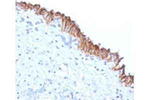 IHC testing of FFPE human bladder carcinoma with MAML2 antibody (clone MMLP2-1). (MAML2 anticorps)