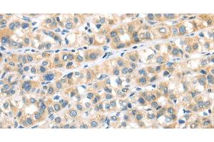 Immunohistochemistry of paraffin-embedded Human esophagus cancer tissue using RIPK4 Polyclonal Antibody at dilution 1:40 (RIPK4 anticorps)