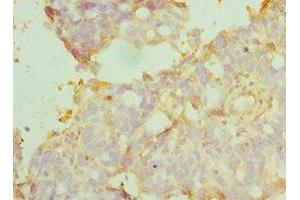 Immunohistochemistry of paraffin-embedded human endometrial cancer using ABIN7159417 at dilution of 1:100 (MANF anticorps  (AA 25-182))