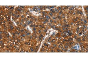 Immunohistochemistry of paraffin-embedded Human liver cancer using CTBP1 Polyclonal Antibody at dilution of 1:40