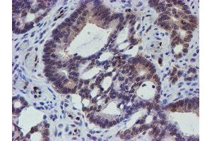 Immunohistochemical staining of paraffin-embedded Adenocarcinoma of Human colon tissue using anti-ELK3 mouse monoclonal antibody. (ELK3 anticorps)