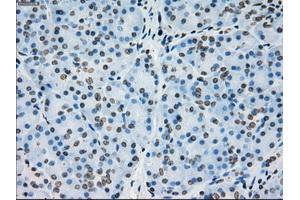 Immunohistochemical staining of paraffin-embedded Adenocarcinoma of colon tissue using anti-PRKYmouse monoclonal antibody. (PRKY anticorps)