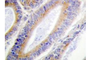 Immunohistochemistry analyzes of Casein Kinase I α antibody in paraffin-embedded human colon carcinoma tissue. (CSNK1A1 anticorps)