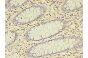 Immunohistochemistry of paraffin-embedded human colon cancer using ABIN7145885 at dilution of 1:100