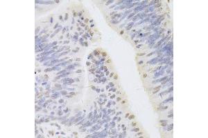 Immunohistochemistry of paraffin-embedded human rectal cancer using HDGF Antibody. (HDGF anticorps  (AA 1-240))