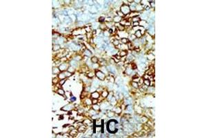 Formalin-fixed and paraffin-embedded human cancer tissue reacted with the primary antibody, which was peroxidase-conjugated to the secondary antibody, followed by AEC staining. (MAP4K2 anticorps  (AA 288-319))
