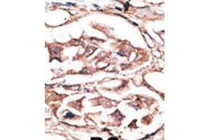 Formalin-fixed and paraffin-embedded human cancer tissue reacted with the primary antibody, which was peroxidase-conjugated to the secondary antibody, followed by AEC staining.