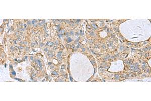 Immunohistochemistry of paraffin-embedded Human thyroid cancer tissue using CLTB Polyclonal Antibody at dilution of 1:70(x200)