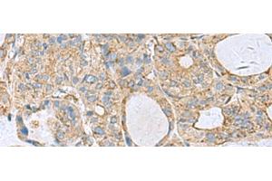 Immunohistochemistry of paraffin-embedded Human thyroid cancer tissue using CLTB Polyclonal Antibody at dilution of 1:70(x200) (CLTB anticorps)