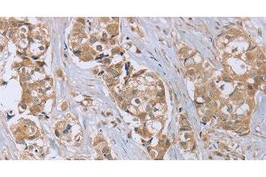 Immunohistochemistry of paraffin-embedded Human breast cancer tissue using RAB6C Polyclonal Antibody at dilution 1:45 (WTH3DI anticorps)