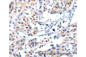 Immunohistochemistry of Human lung cancer using FBLN5 Polyclonal Antibody at dilution of 1:85 (Fibulin 5 anticorps)