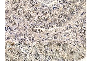Estrogen Receptor-alpha Antibody at 1/100 staining human lung cancer by IHC-P.