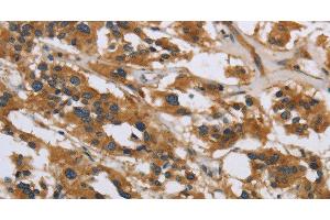 Immunohistochemistry of paraffin-embedded Human thyroid cancer using IL5RA Polyclonal Antibody at dilution of 1:40 (IL5RA anticorps)