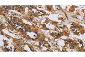 Immunohistochemistry of paraffin-embedded Human thyroid cancer using IL5RA Polyclonal Antibody at dilution of 1:40 (IL5RA anticorps)