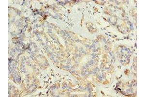 Immunohistochemistry of paraffin-embedded human breast cancer using ABIN7173703 at dilution of 1:100 (TUBG2 anticorps  (AA 276-451))