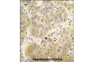 Formalin-fixed and paraffin-embedded human hepatocarcinoma tissue reacted with the VARS antibody , which was peroxidase-conjugated to the secondary antibody, followed by DAB staining. (VARS anticorps  (N-Term))
